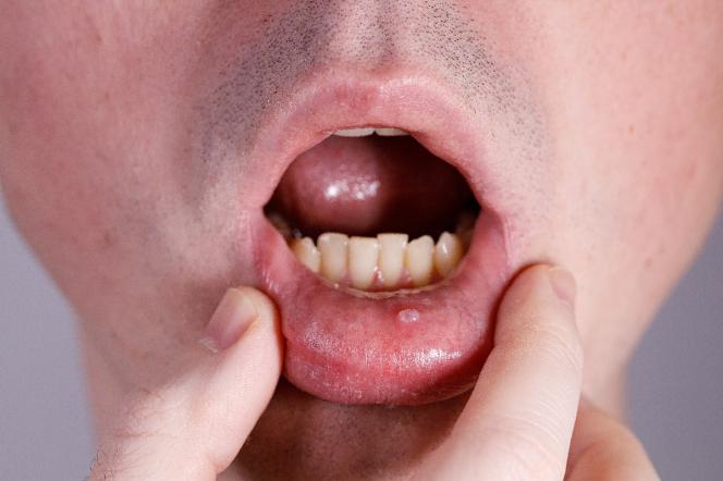 Ретенционная киста губы