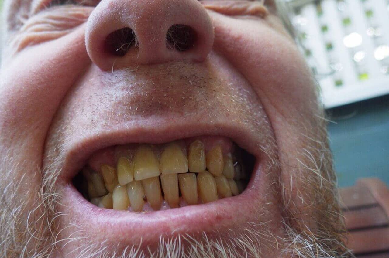 фото поврежденных зубов