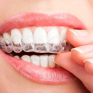 Способ n1 для отбеливания зубов